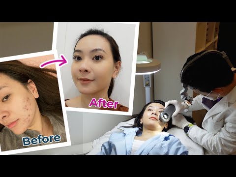 How I clear my acne | My travel skincare routine