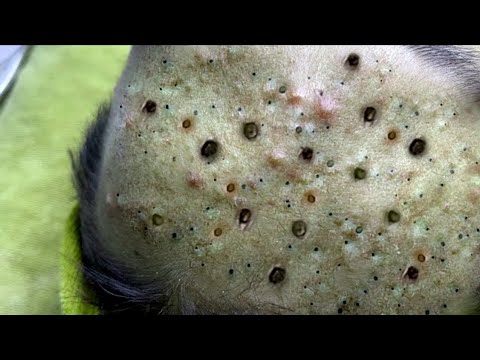 Blackheads: What They Look Like, Treatment & Prevention Spa51