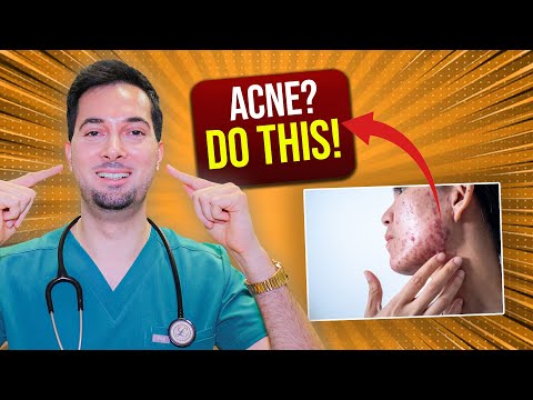 How To Get Rid Of Acne Overnight And Pimples | Pharmacist Explains