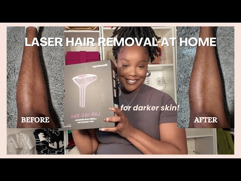 True Laser Never Disappoints! 4 Weeks with DermRays V6S for Darker Skin | Before & After Results