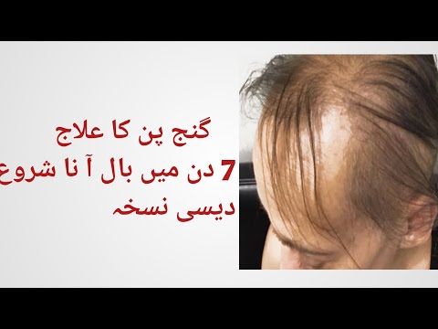 #Ganjapan ka desi gharelu ilaj, || Hair fall treatment || urdu / hindi