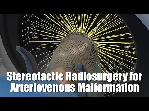 Stereotactic Radiosurgery for Arteriovenous Malformation (AVM)