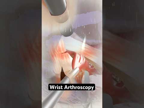 Wrist arthroscopy (3D animation)