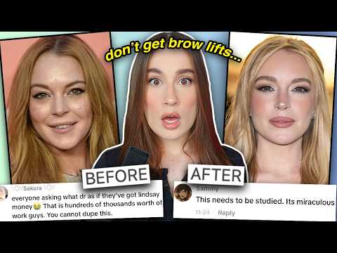 BROW LIFTS ARE RUINING YOUR FACE (scientifically proven)